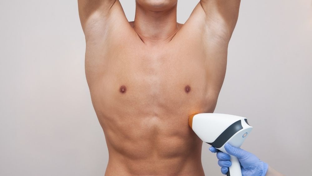 Depilação a laser no Abdômen masculino
